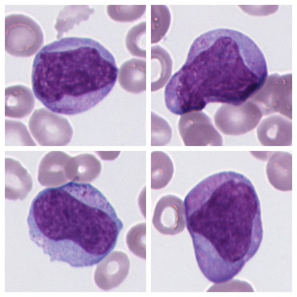 Promyelocyte (Atypical)